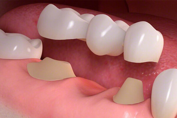 dental inlay
