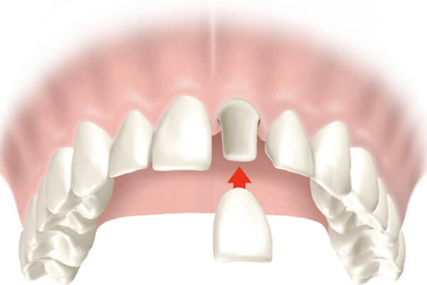 intraoral x-ray
