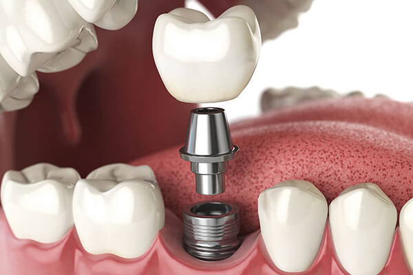 best tooth implants
