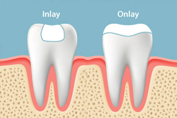 dental inlays and onlays
