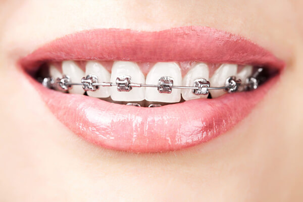 all on 4 dental implants
