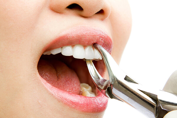 teeth extraction at dentist