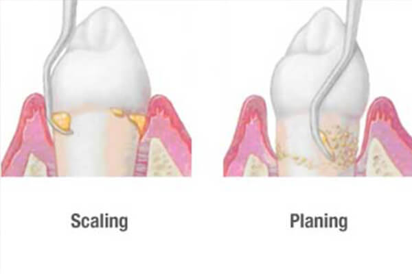teeth scaling procedure